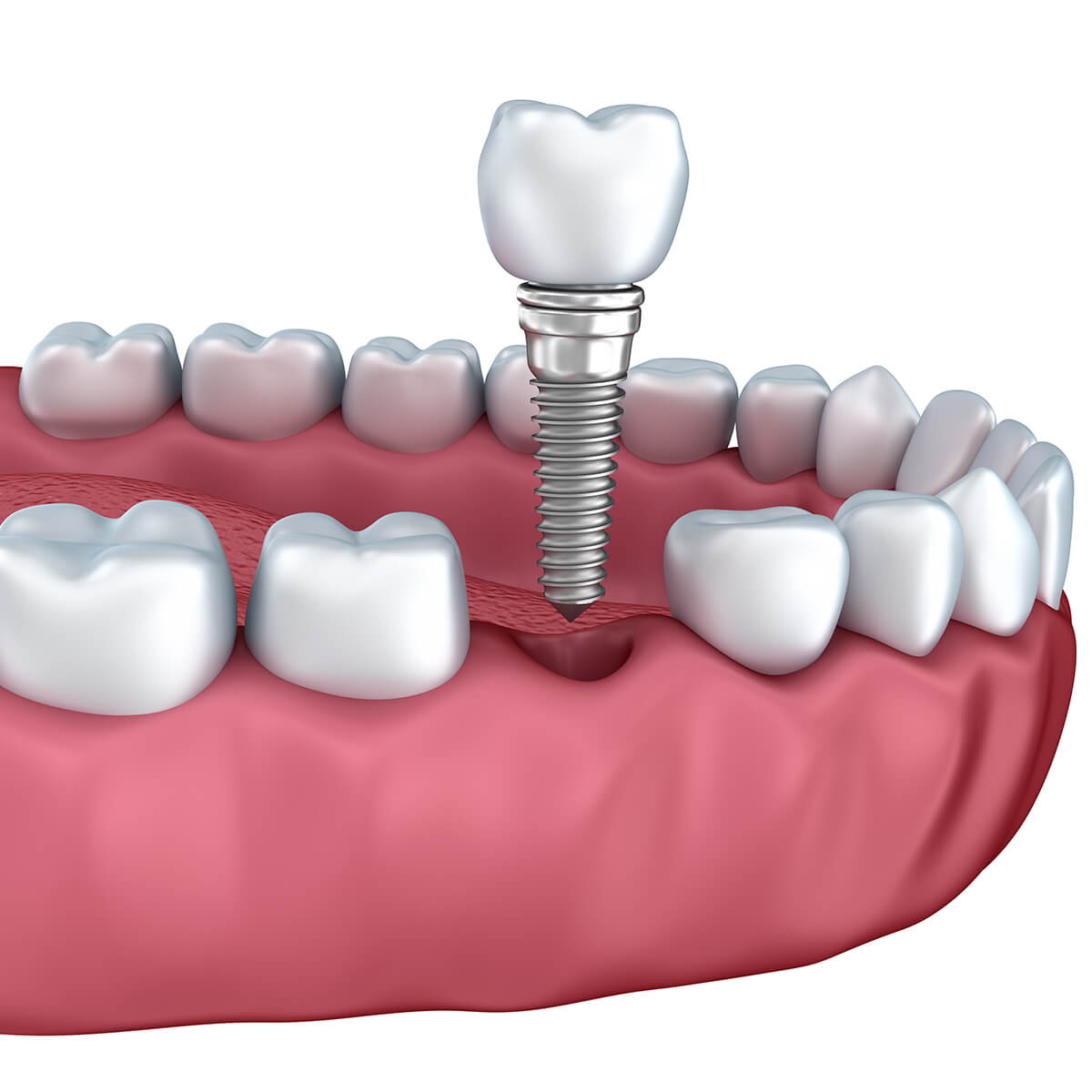 Process of Dental Implants in Manhattan Beach CA Area
